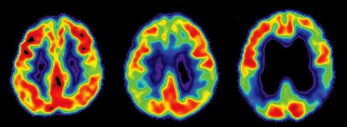 Petscan dans la maladie d'Alzheimer